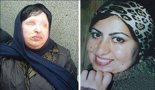 آمنه بهرامی، قربانی اسیدپاشی از عامل جنایت شکایت کرد آمنه بهرامی، قربانی اسیدپاشی از عامل جنایت شکایت کرد