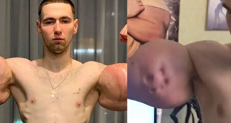 ببینید| بدنساز ۲۹ ساله روس در آستانه قطع هر ۲ دست بخاطر تزریق بیش از حد ژل!