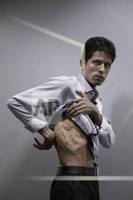 محمد الغربی، روزنامه نگاری که توسط حوثی ها اسیر شده و مورد شکنجه واقع شده در این تصویر جای زخم های خود را نشان میدهد.