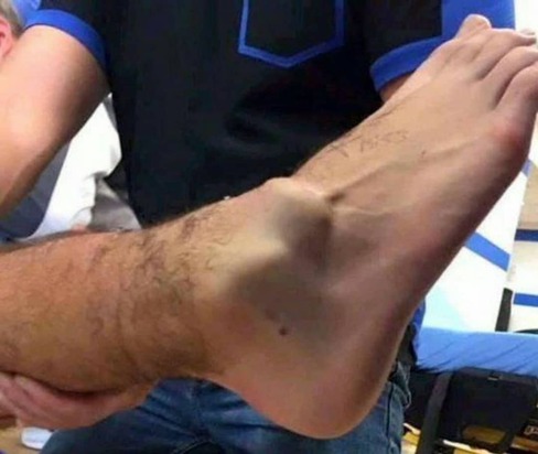 مصدومیت گومز