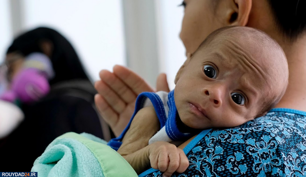 سوء تغذیه در کودکان ونزوئلا