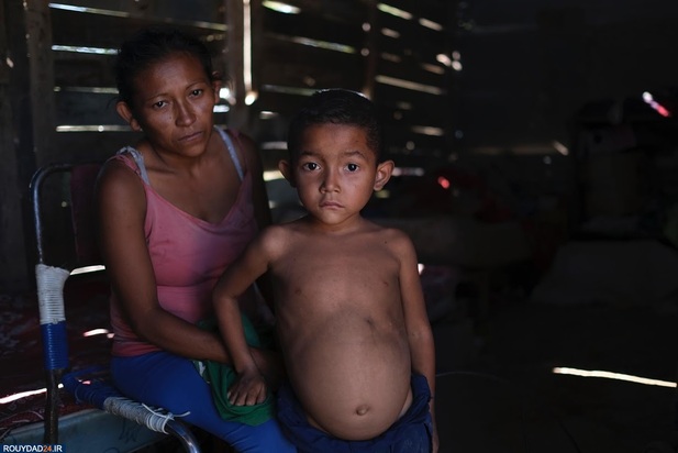 سوء تغذیه در کودکان ونزوئلا