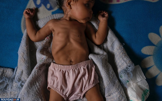 سوء تغذیه در کودکان ونزوئلا