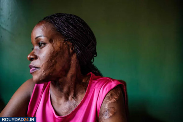 اسیدپاشی در اوگاندا