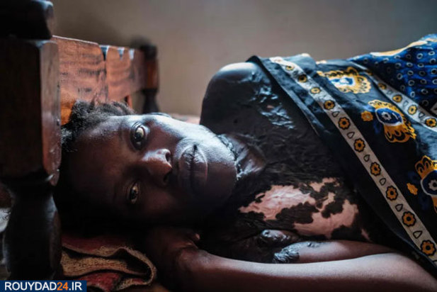 اسیدپاشی در اوگاندا