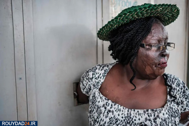 اسیدپاشی در اوگاندا