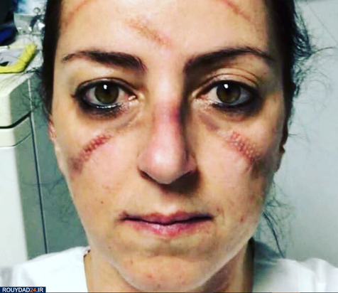 رد ماسک روی صورت پرستاران