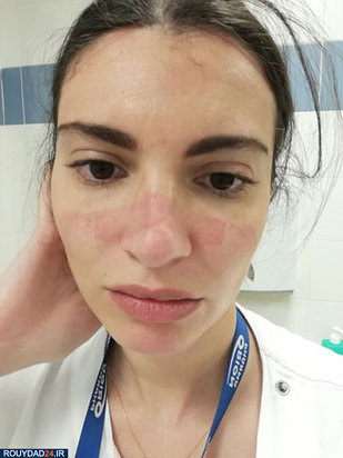 رد ماسک روی صورت پرستاران