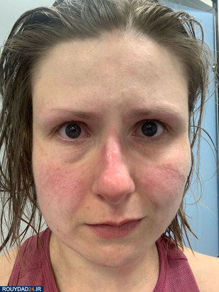 رد ماسک روی صورت پرستاران