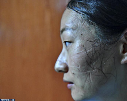 رد ماسک روی صورت پرستاران