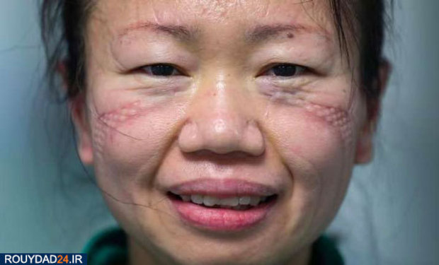 رد ماسک روی صورت پرستاران