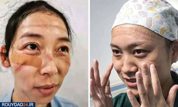 رد ماسک روی صورت پرستاران