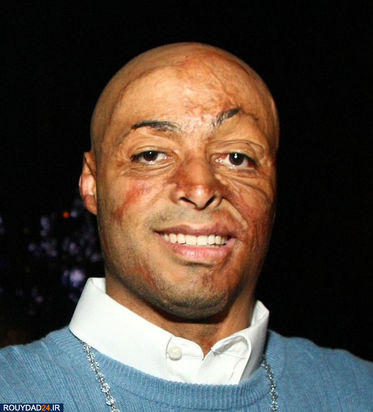 زخمهای سلبها