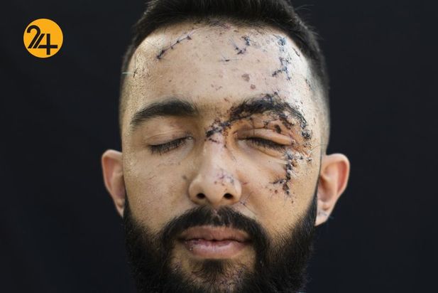 زخمهای انفجار بیروت