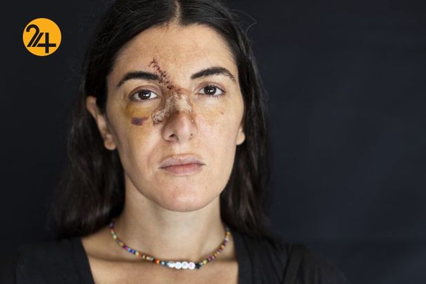 زخمهای انفجار بیروت