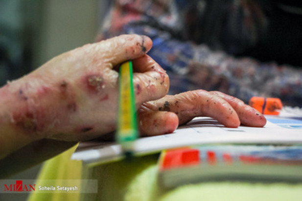 زندگی با زخم پروانه ای