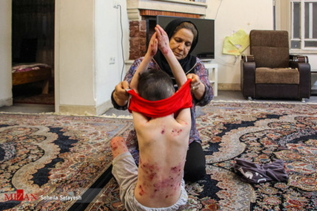 زندگی با زخم پروانه ای