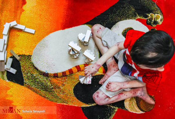 زندگی با زخم پروانه ای