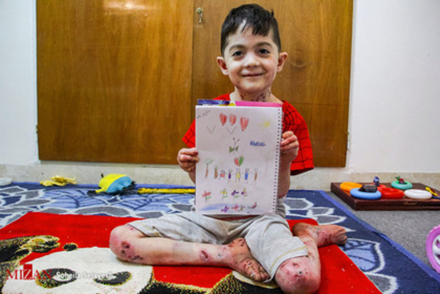 زندگی با زخم پروانه ای