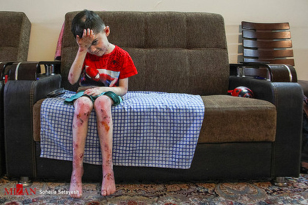 زندگی با زخم پروانه ای