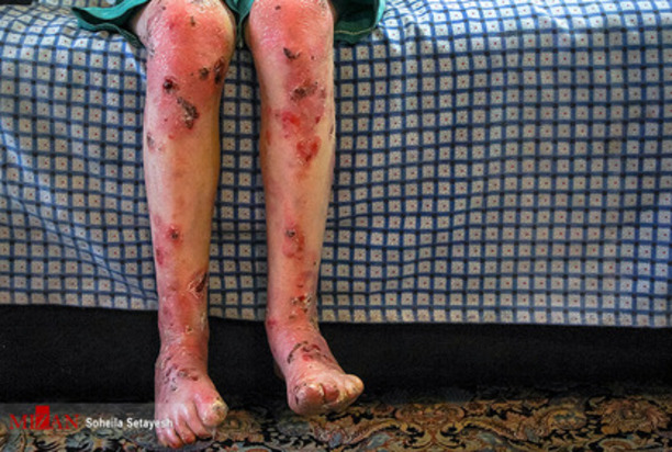 زندگی با زخم پروانه ای