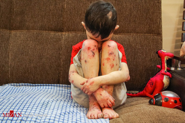 زندگی با زخم پروانه ای