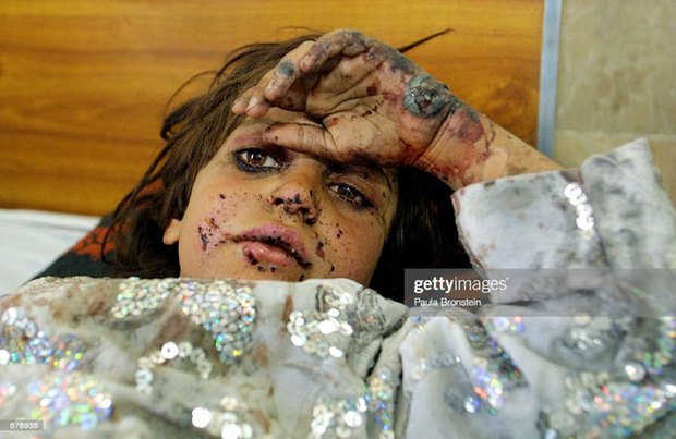 کودکان زخمی و معلول در جنگ افغانستان