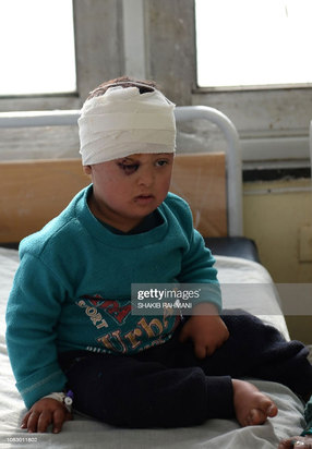 کودکان زخمی و معلول در جنگ افغانستان