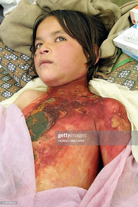 کودکان زخمی و معلول در جنگ افغانستان