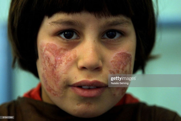 کودکان زخمی و معلول در جنگ افغانستان