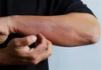 بلاهایی که کرونا بر سر پوست می‌آورد/ این ۸ عارضه بشناسید