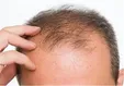 راهکار‌های طب سنتی برای جلوگیری از ریزش مو