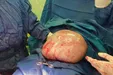 توده ۵ کیلویی از شکم بیمار سردشتی خارج شد