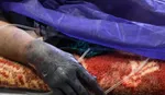 ۴۲۷ نفر در حوادث چهارشنبه سوری مصدوم شدند | ۲۰ نفر قطع عضو