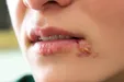 تبخال زدن بیش از ۲ بار در سال غیر عادی است!