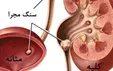 خروج یک کیلو سنگ از مثانه دختر ۱۸ ساله بندرعباسی