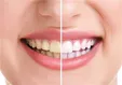 ۱۰ راز برای داشتن دندان‌های سفیدتر و درخشان‌تر