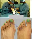 جراحی سیندرلایی کردن پا +عکس