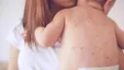 هشدار درباره طغیان سرخک در ایران / مشاهده ۲۵ مورد ابتلا در برخی استان‌ها
