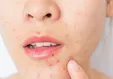 ۴ باور غلط در مورد جوش صورت که از آن‌ها بی‌خبرید