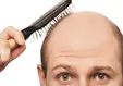 دلایل طاسی پس از ابتلا به ویروس کرونا