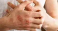 پوست کرونایی چه نشانه‌ای دارد؟