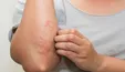 علائم و نشانه‌های جدید پوستی کرونا
